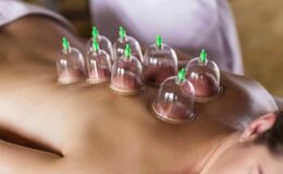 cupping therapy